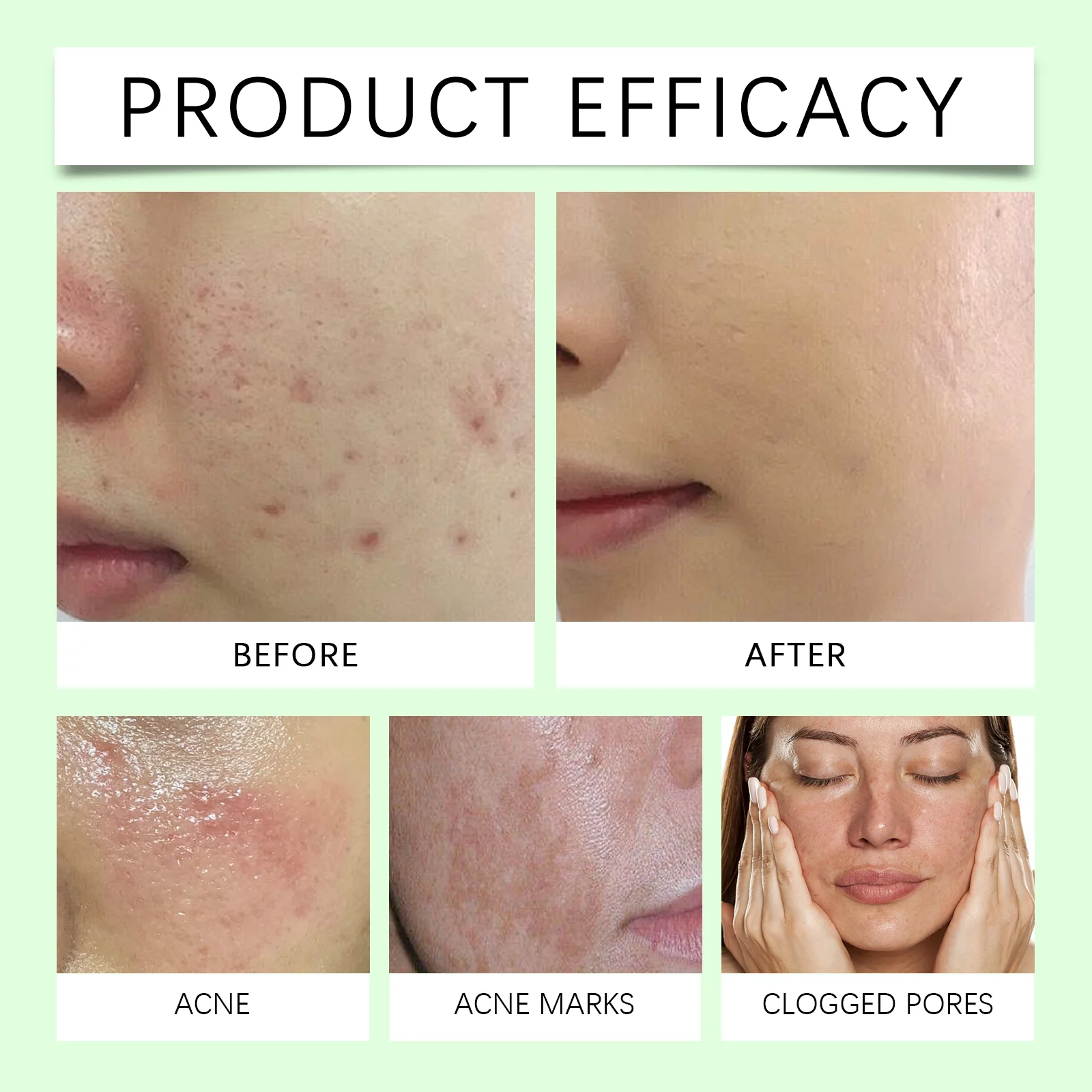 Acne Removal Cream for Face 50g Soothing Anti-Inflammatory Treatment to Fade Marks and Minimize Pores 9 acne removal cream 50g soothing anti inflammatory wes nkcfc46u desc 9