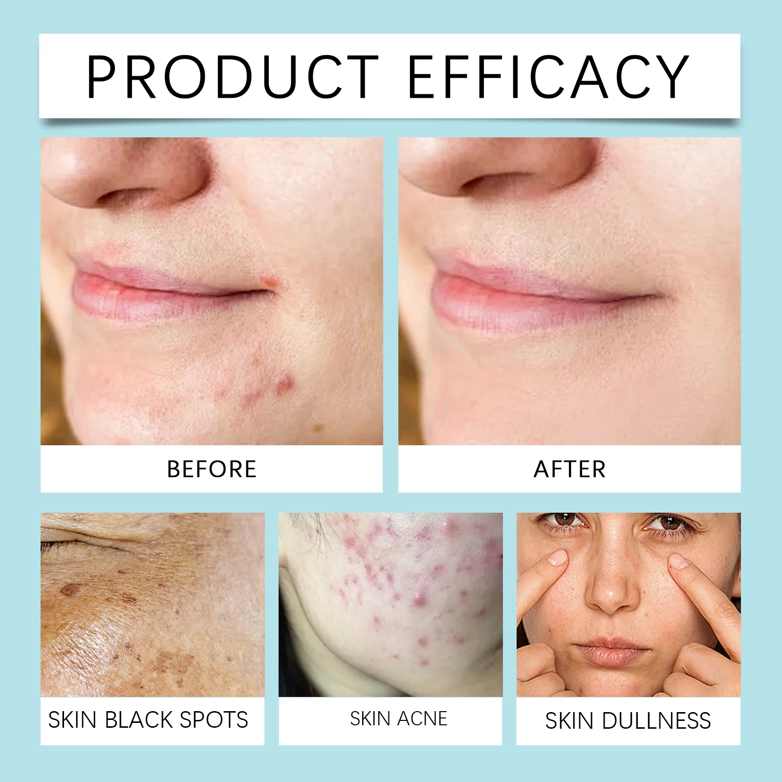 West Month Acne Scar Remover Essence with Zebrafish Protein, Facial Treatment Cream for Skin Repair & Moisturizing 9 acne scar remover essence cream wes 8yrn6rd3 desc 9