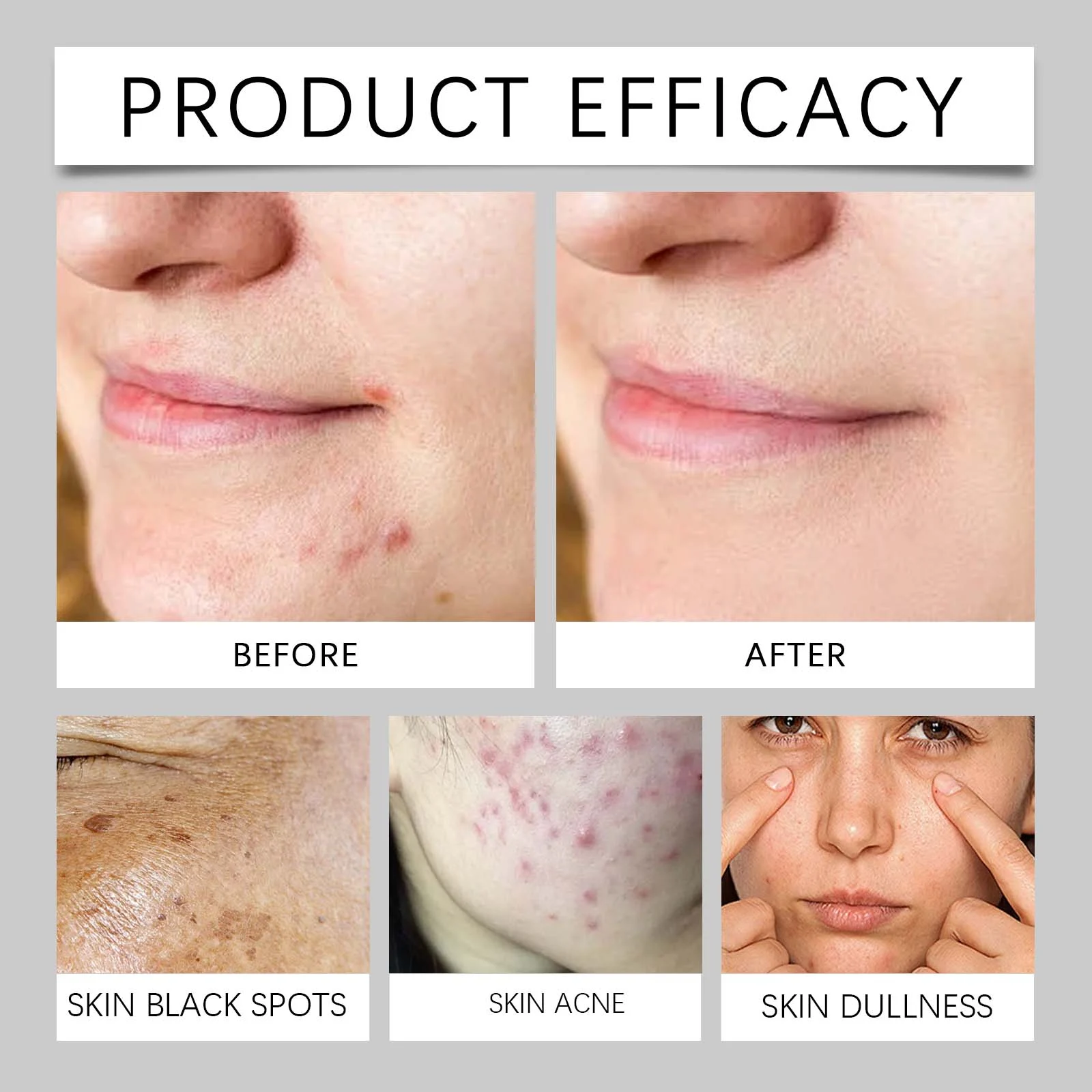 Acne Treatment Cream 50g for Oily & Acne-Prone Skin with Zinc Oxide & Tea Tree Oil 9 acne treatment cream 50g zinc oxide tea tree oil wes urr9nzwu desc 9