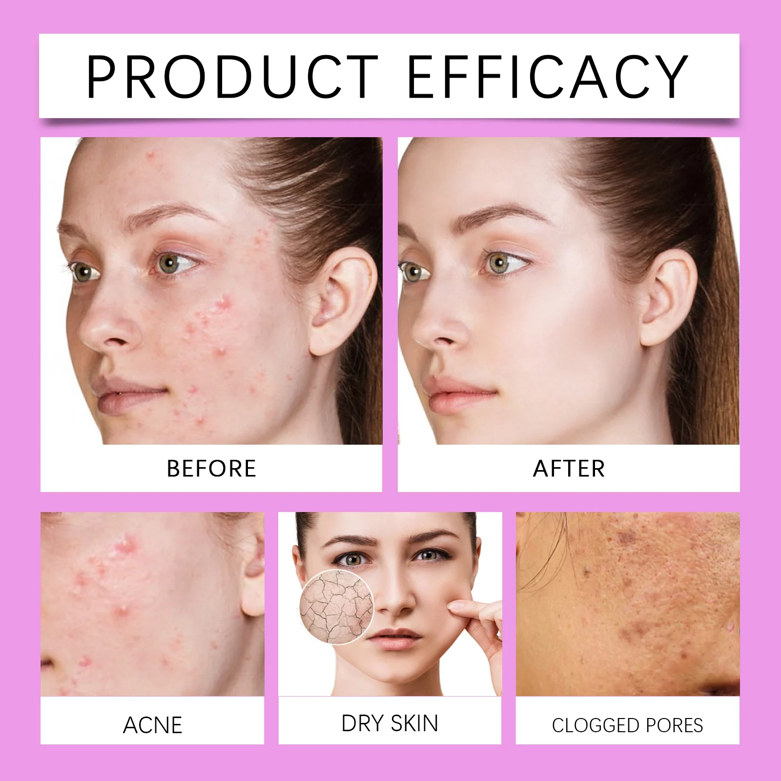 Azelaic Acid Cream 20g Gentle Acne Treatment for Clear, Smooth Skin 9 azelaic acid cream 20g acne treatment wes xwfav4ux desc 9