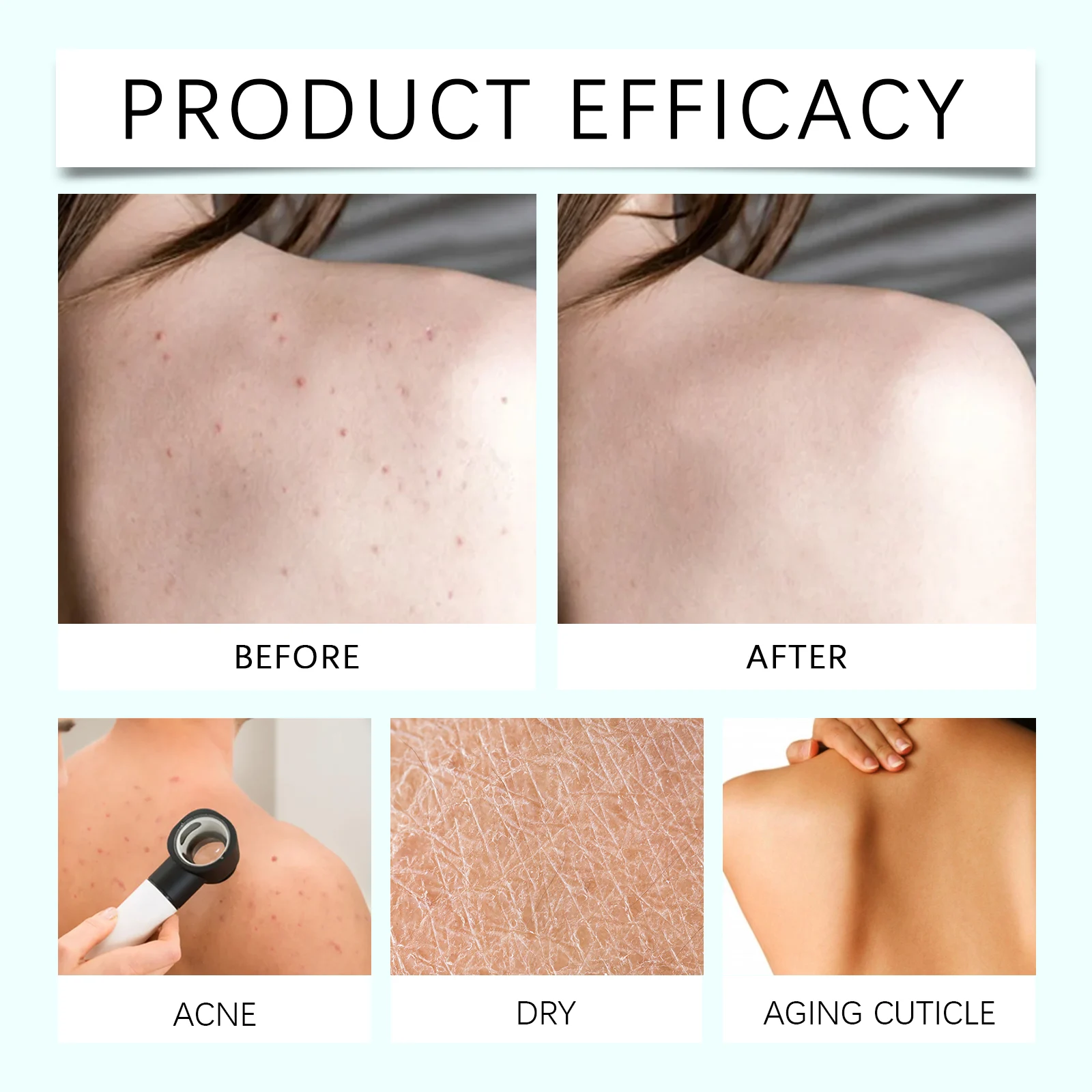 Back Acne Herbal Spray 100ml with Tea Tree Oil for Deep Cleansing & Oil Regulation 12 back acne herbal spray 100ml tea tree oil wes drhxyx28 desc 12