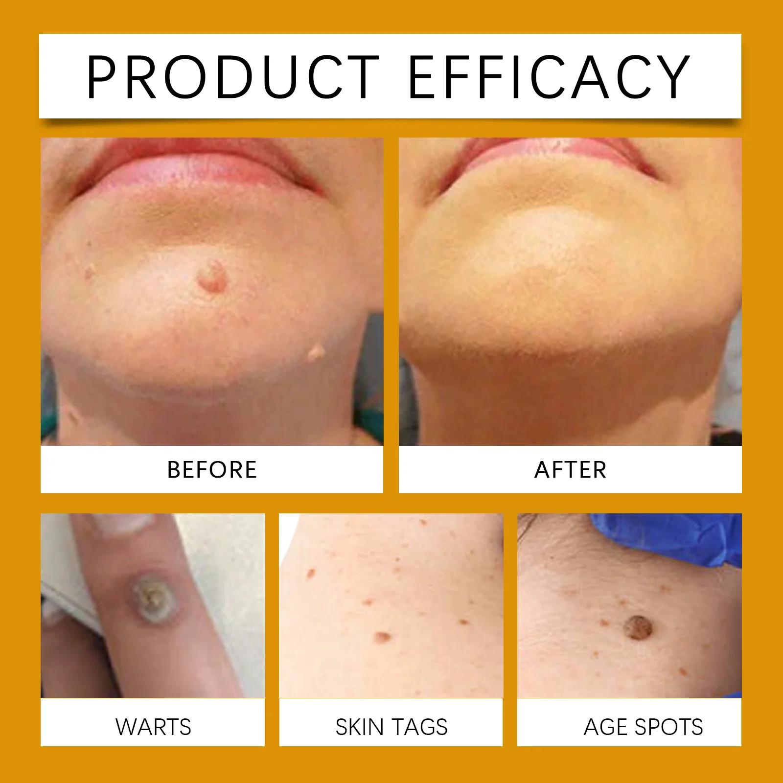 Bee Venom Wart & Mole Removal Cream Smooth Skin Texture Wart Care Treatment 30g 9 bee venom wart mole removal cream 30g wes jrrt7rw2 desc 9