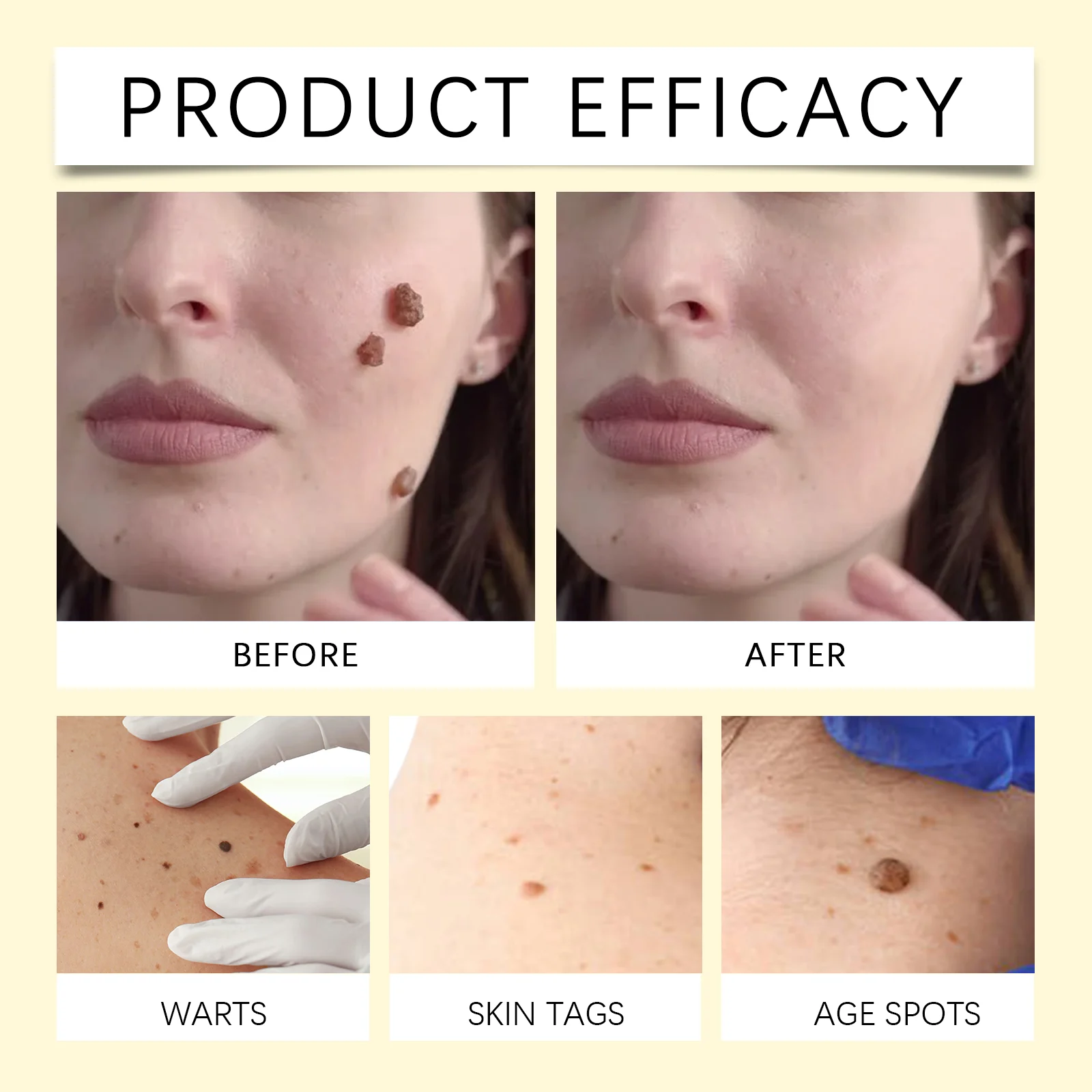 Bee Venom Wart Removal Cream Skin Tag Mole Remover Treatment 50g 9 bee venom wart removal cream skin tag mole remover treatment 50g wes ekdm2cvw desc 9