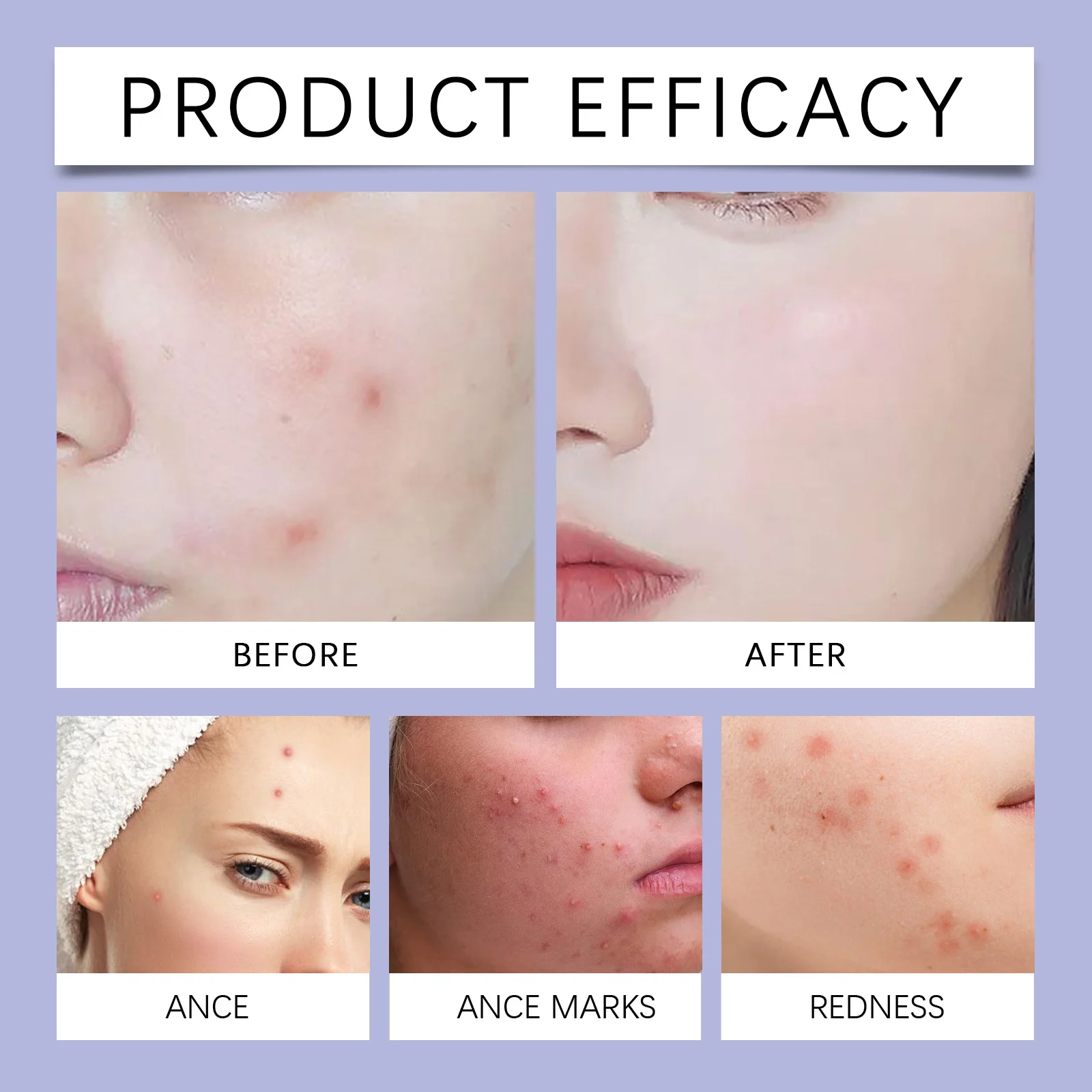 Pimple Patches for Face Color Concealing Acne Stickers with Antioxidant Care 240 Patches 9 pimple patches color concealing acne stickers 240 patches wes fusvaf73 desc 9
