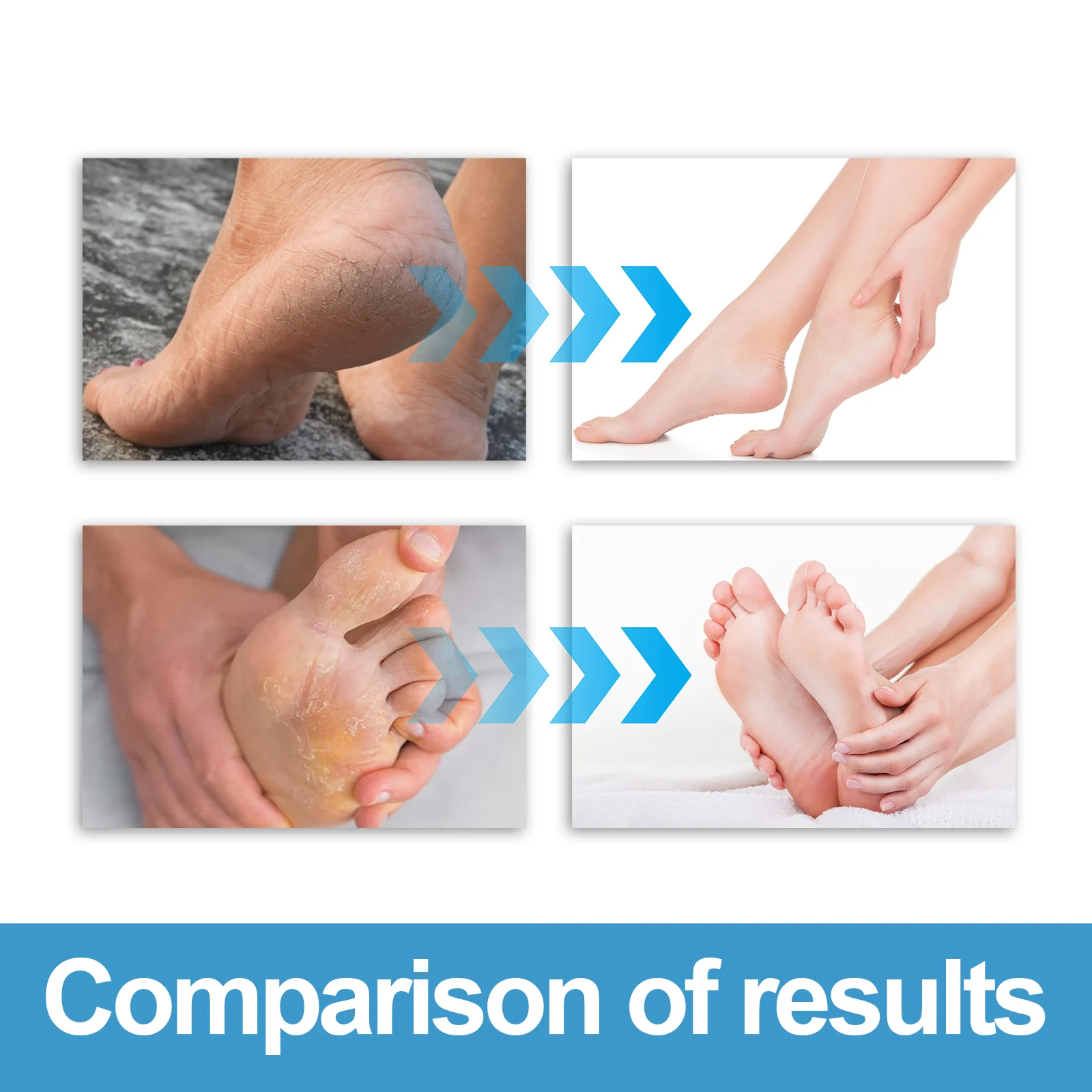 Foot Peeling Cream 50g - Repair, Moisturize & Remove Calluses for Soft Feet 8 foot peeling cream 50g repair moisturize callus remover wes m2p26we5 desc 8