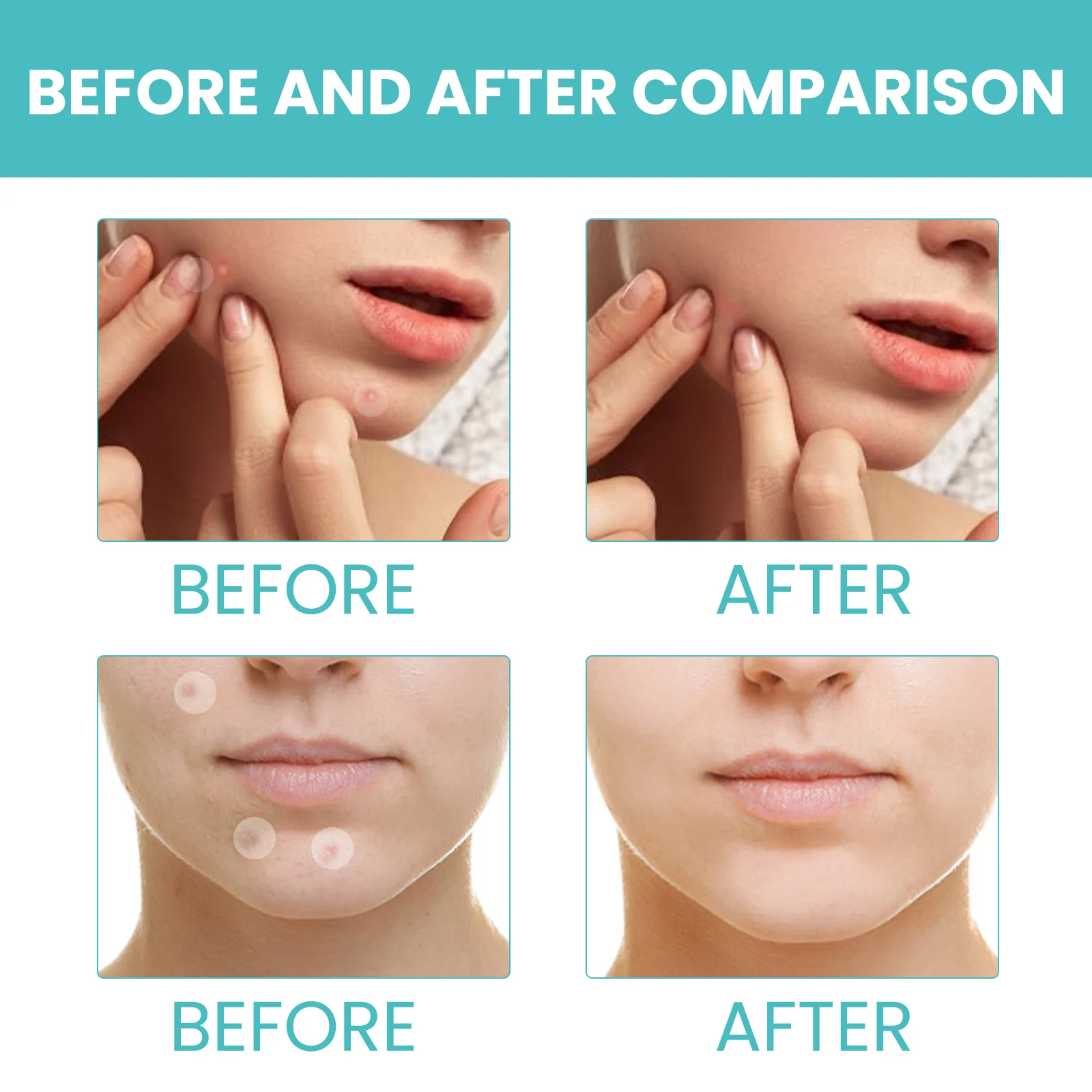 West Month Pimple Patches 300pcs Hydrocolloid Invisible Acne Healing 10 hydrocolloid acne pimple patches wes btfhejgn desc 10