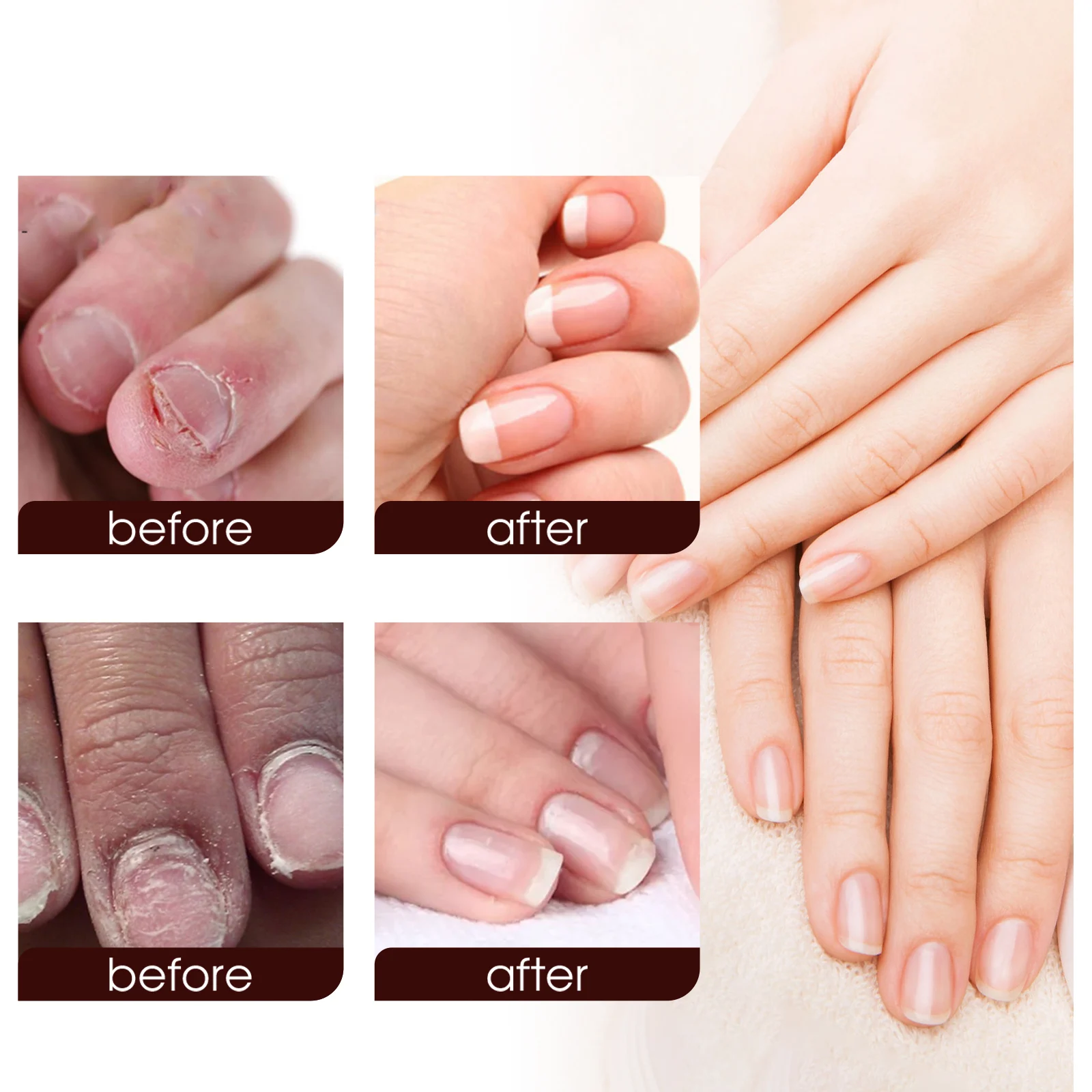 Nail Repair Treatment Gel 20g for Toenail Health, Moisturizing & Luster, Maximum Strength Formula 8 nail repair treatment gel 20g wes pteyn2g6 desc 8