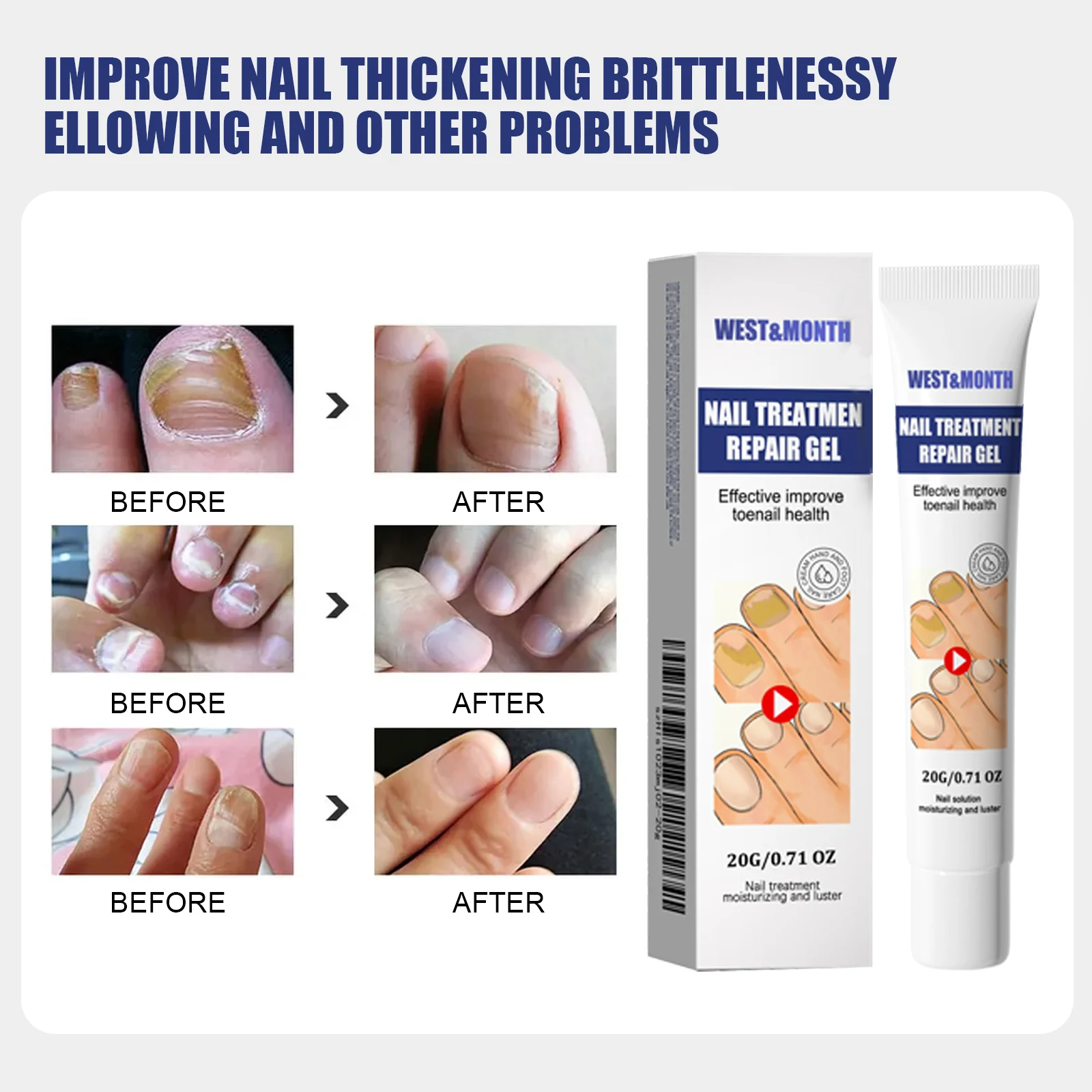 Nail Repair Treatment Gel 20g for Toenail Health, Moisturizing & Luster, Maximum Strength Formula 9 nail repair treatment gel 20g wes pteyn2g6 desc 9
