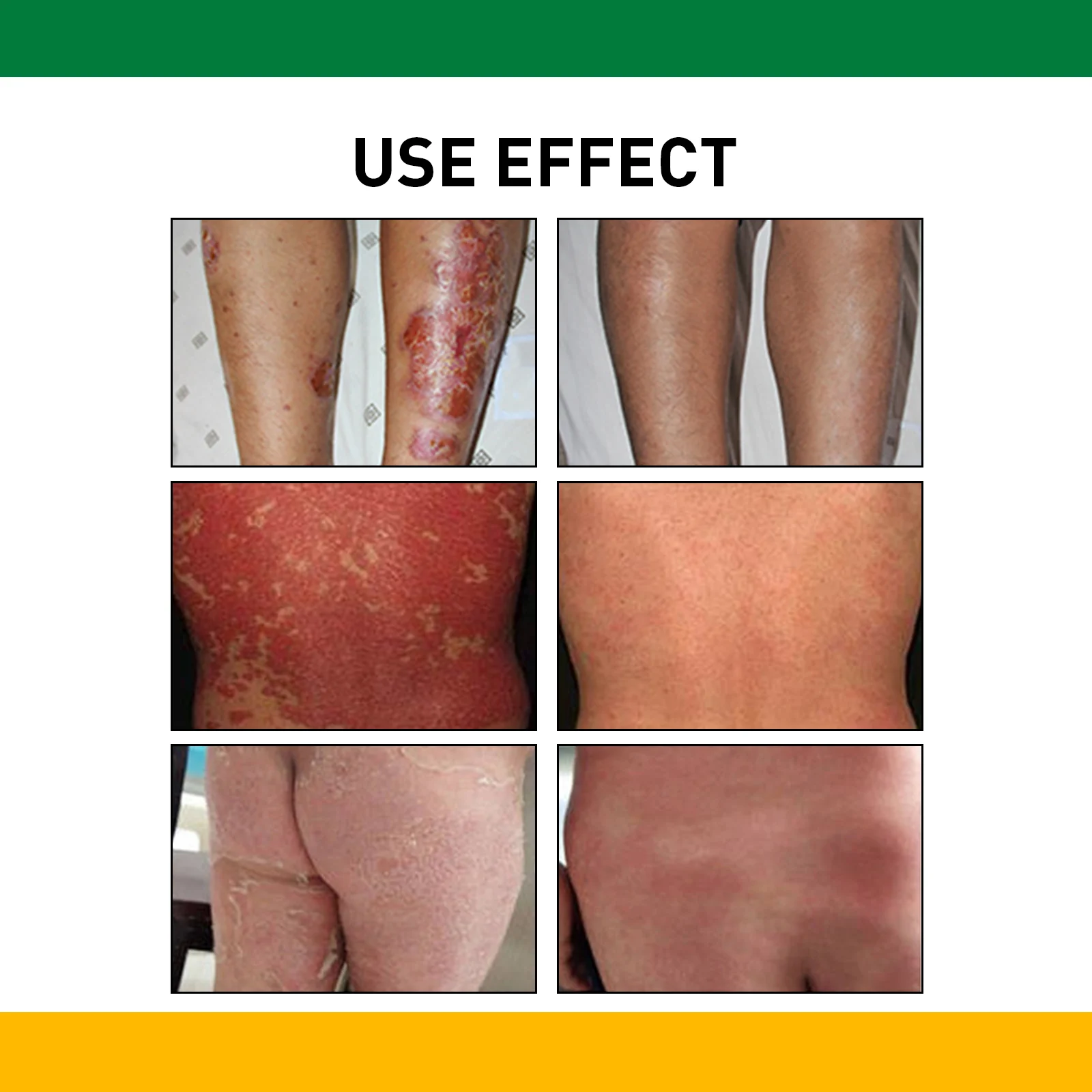 Psoriasis Cream 20g for Eczema & Itchy Skin Relief with Herbal Essence 11 psoriasis cream eczema itchy skin relief herbal 20g wes 93b6yht6 desc 11