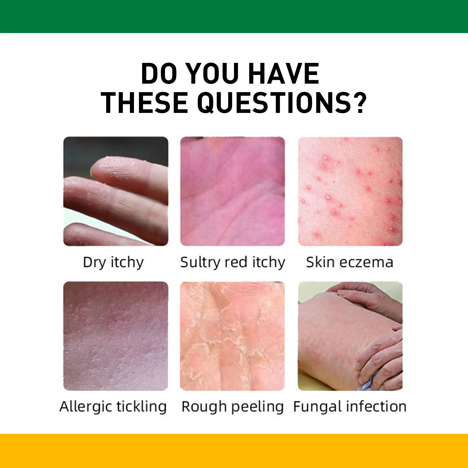 Psoriasis Cream 20g for Eczema & Itchy Skin Relief with Herbal Essence 8 psoriasis cream eczema itchy skin relief herbal 20g wes 93b6yht6 desc 8