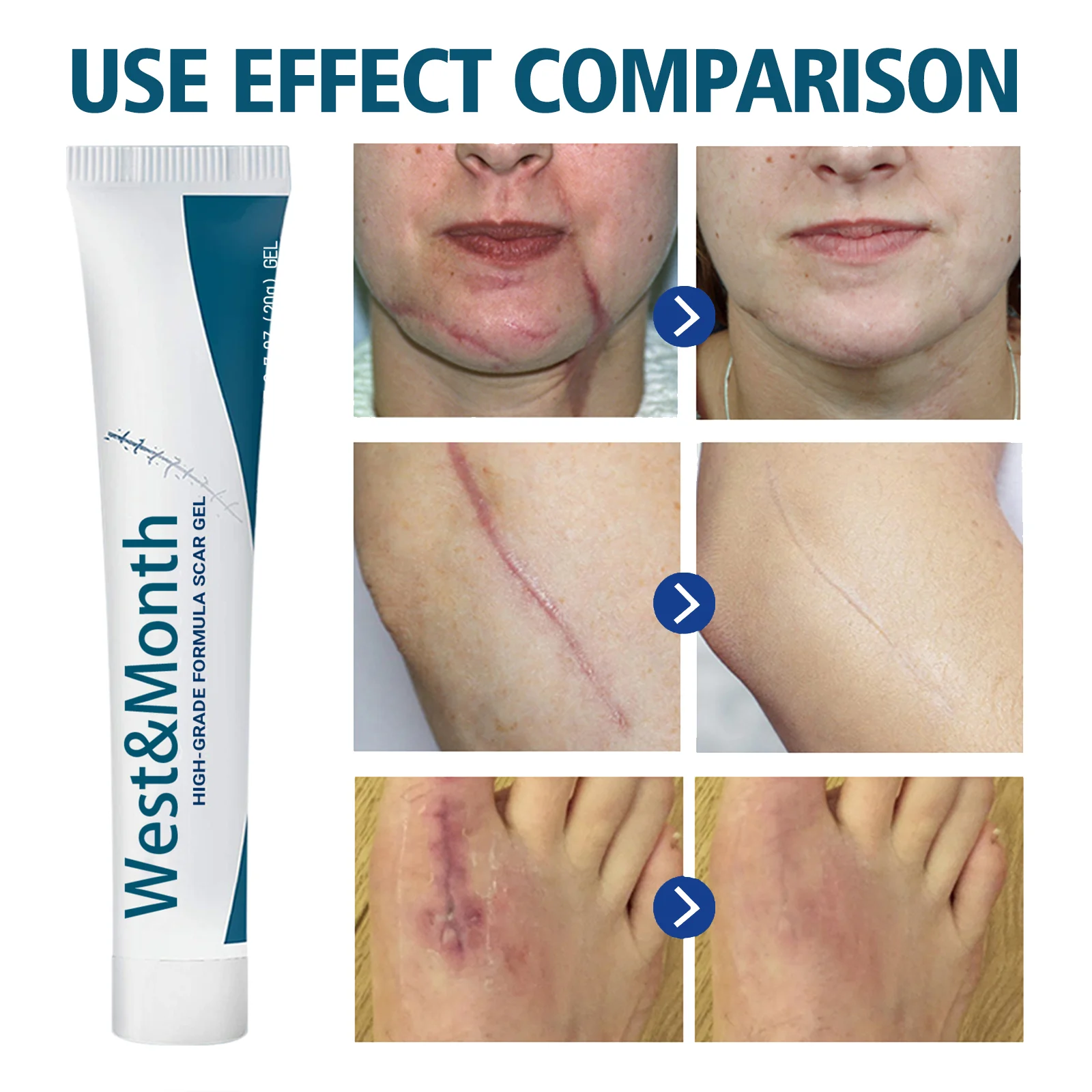 Scar Removal Gel 20g for Old & New Scars, Softens & Flattens Keloids, Post-Surgery & Acne 10 scar removal gel 20g wes jnzadc2q desc 10