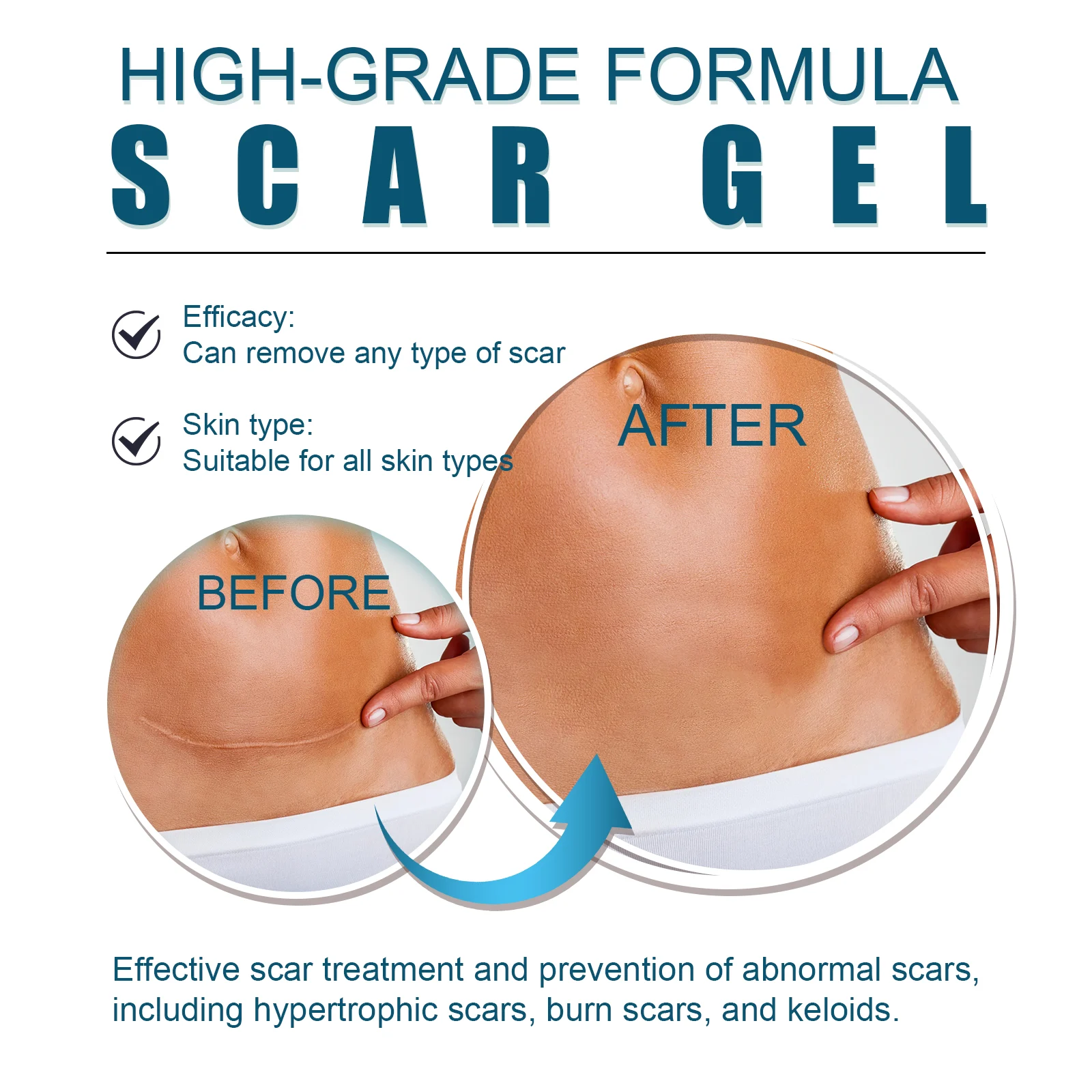 Scar Removal Gel 20g for Old & New Scars, Softens & Flattens Keloids, Post-Surgery & Acne 9 scar removal gel 20g wes jnzadc2q desc 9