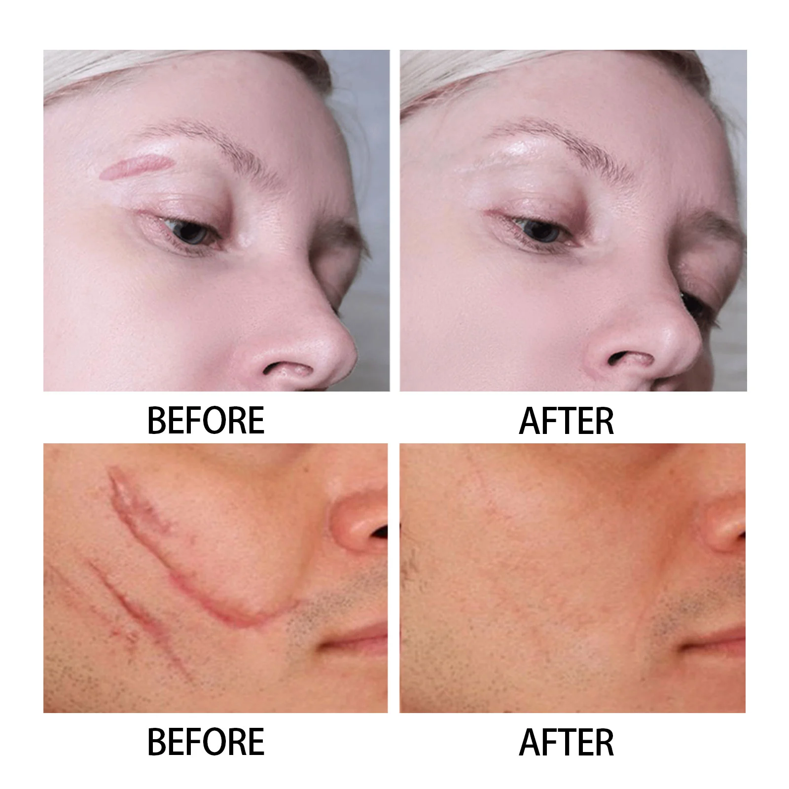 Scar Removal Gel with Centella & Retinol to Repair & Smooth Skin 7 scar removal gel 30ml wes prgghnkp desc 7