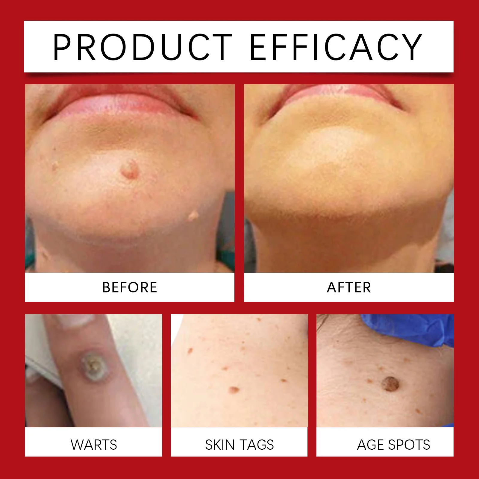 Skin Tags Rosehip Oil 30ml - Wart Removal Essence for Smooth Skin 9 skin tags rosehip oil wart removal 30ml wes 7pmd38t4 desc 9