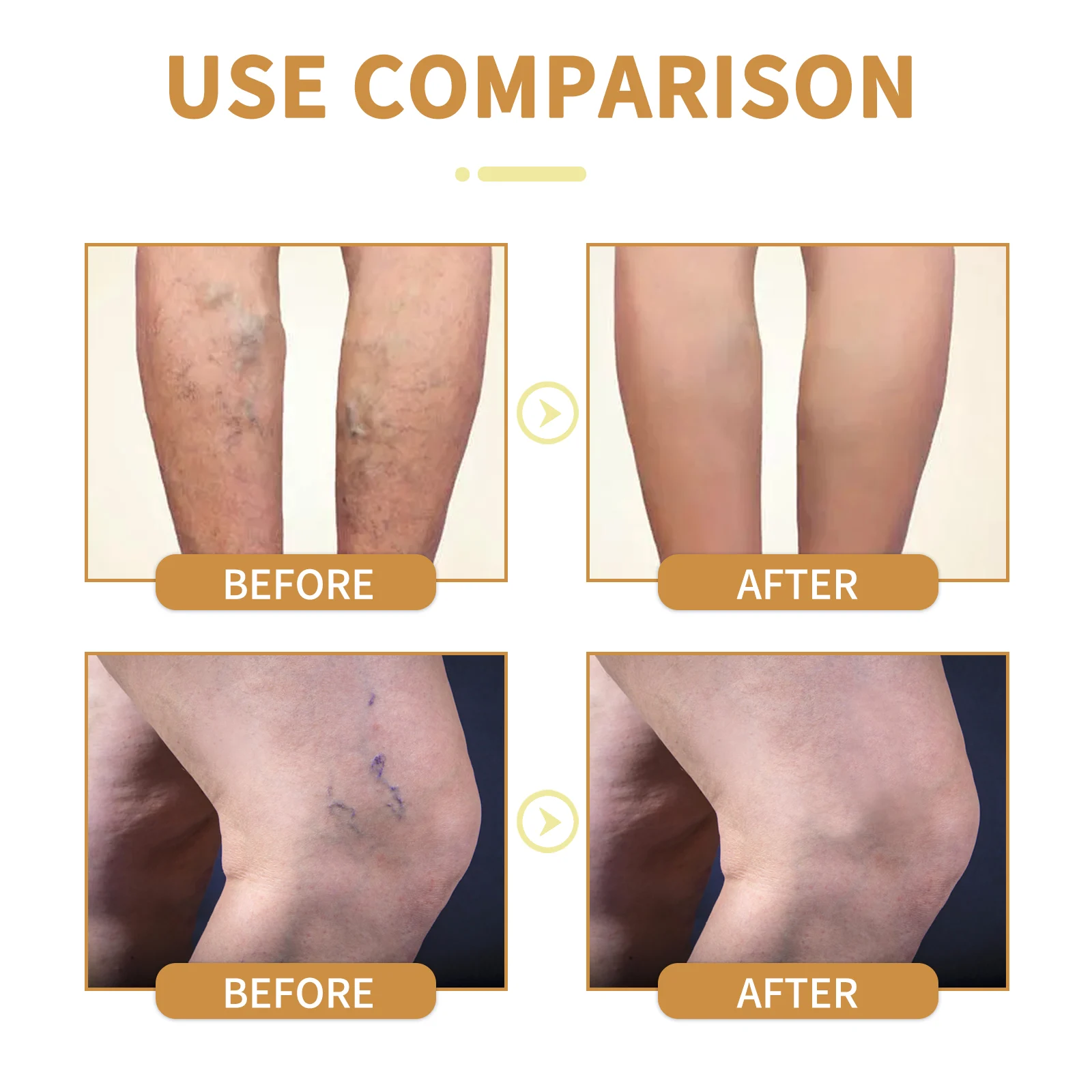 West Month Varicose Vein Cream with Vitamin K & Aloe Vera 8 varicose vein cream wes m6kb75sv desc 8