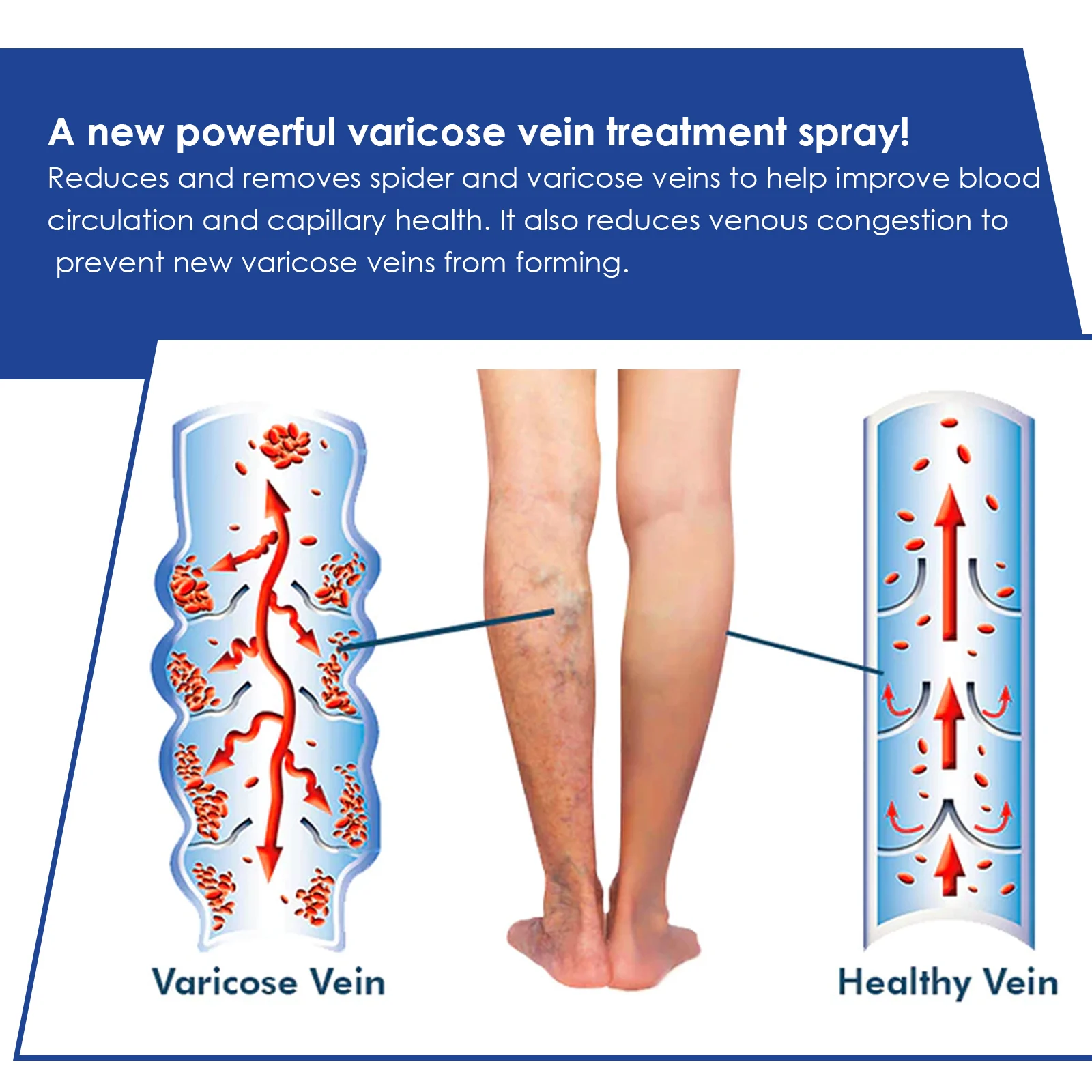 West Month Varicose Vein Spray - Improves Circulation, Reduces Spider & Varicose Veins 7 varicose vein spray leg treatment wes nvzkx923 desc 8
