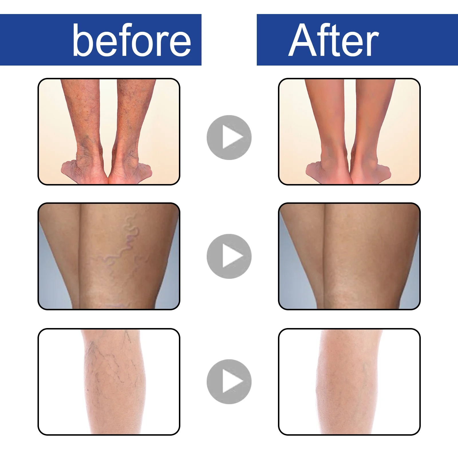 West Month Varicose Vein Spray - Improves Circulation, Reduces Spider & Varicose Veins 8 varicose vein spray leg treatment wes nvzkx923 desc 9